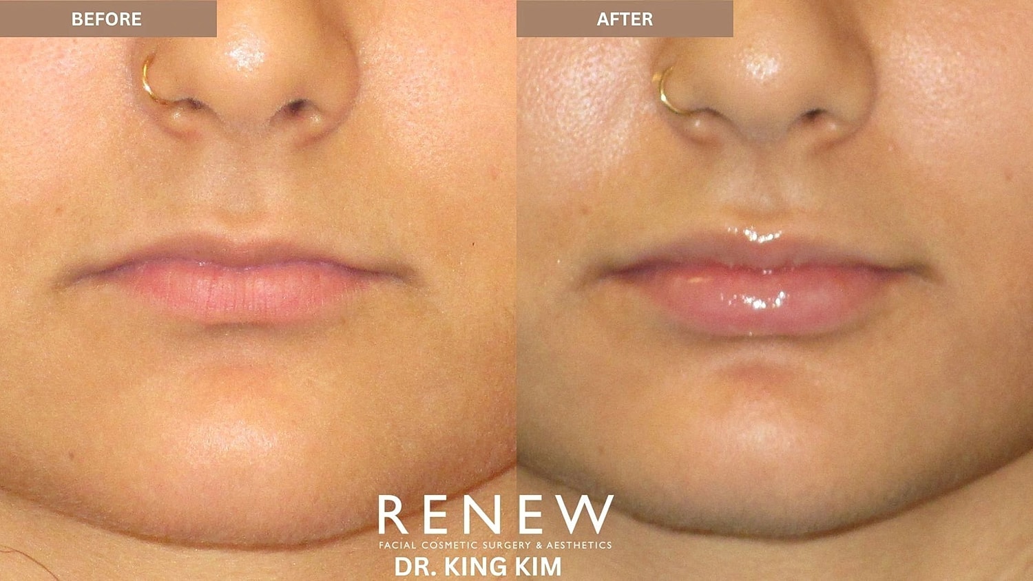 Lips Before & After