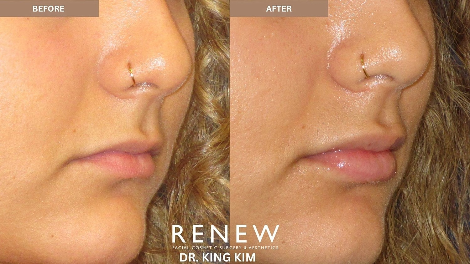Lips Before & After