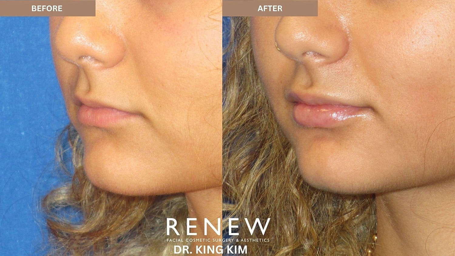 Lips Before & After