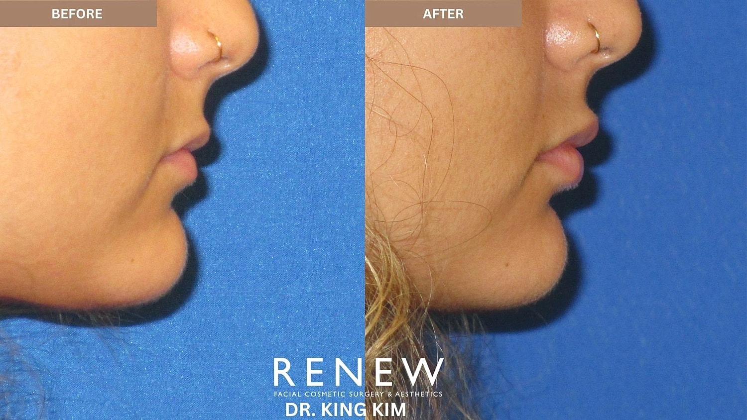 Lips Before & After