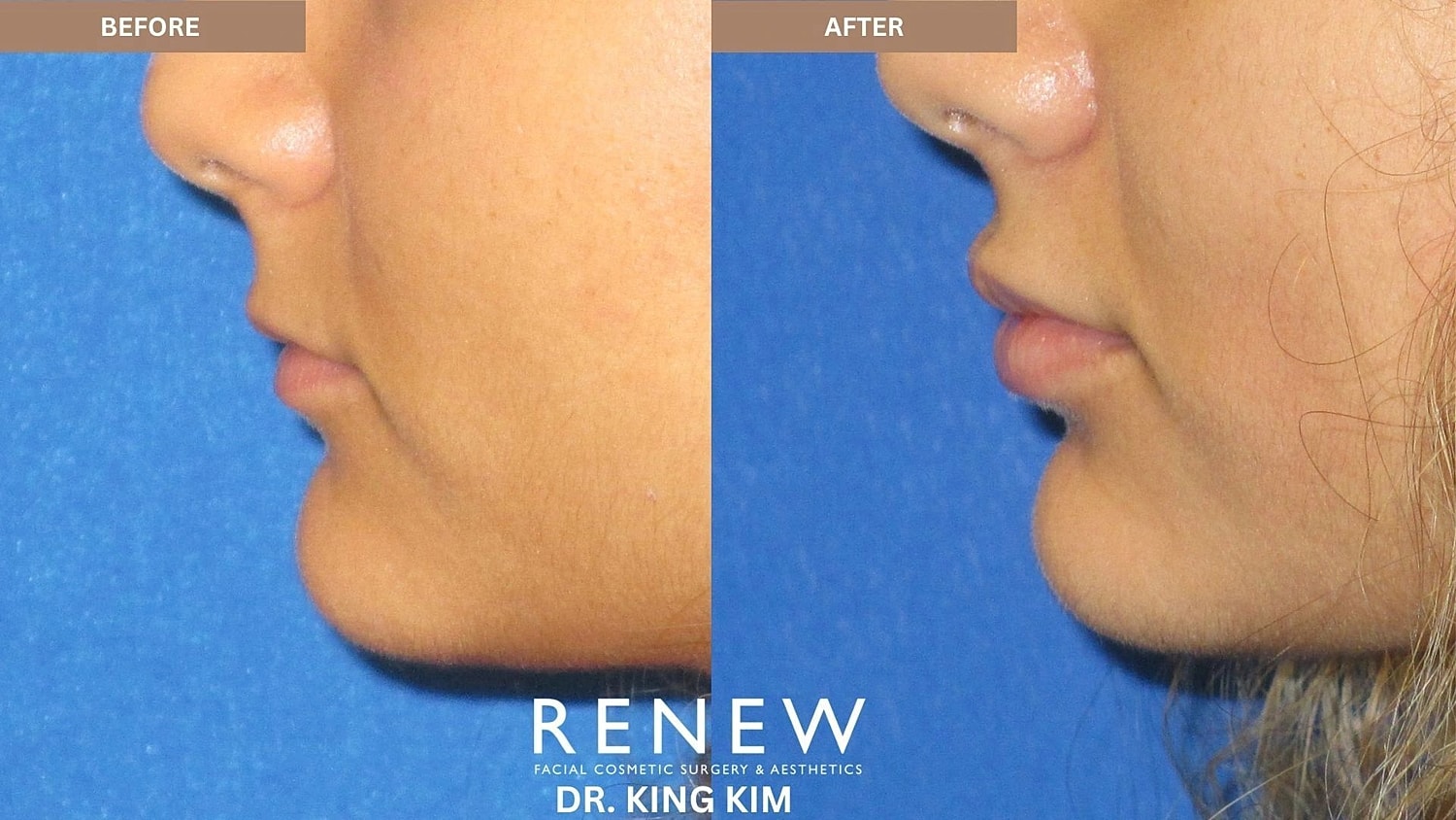 Lips Before & After