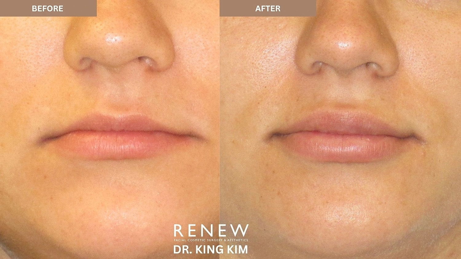 Lips Before & After