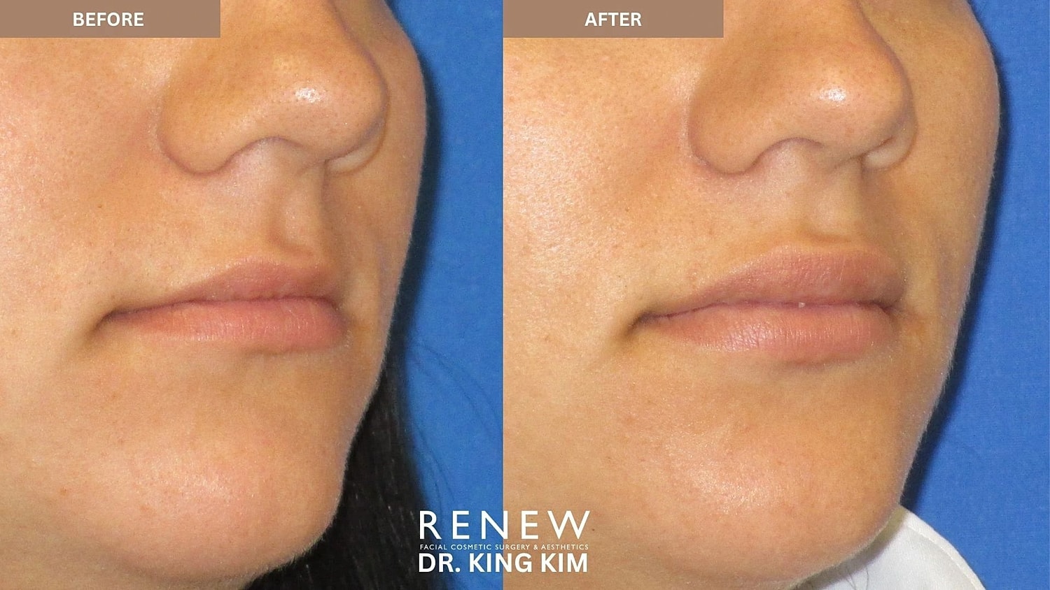 Lips Before & After