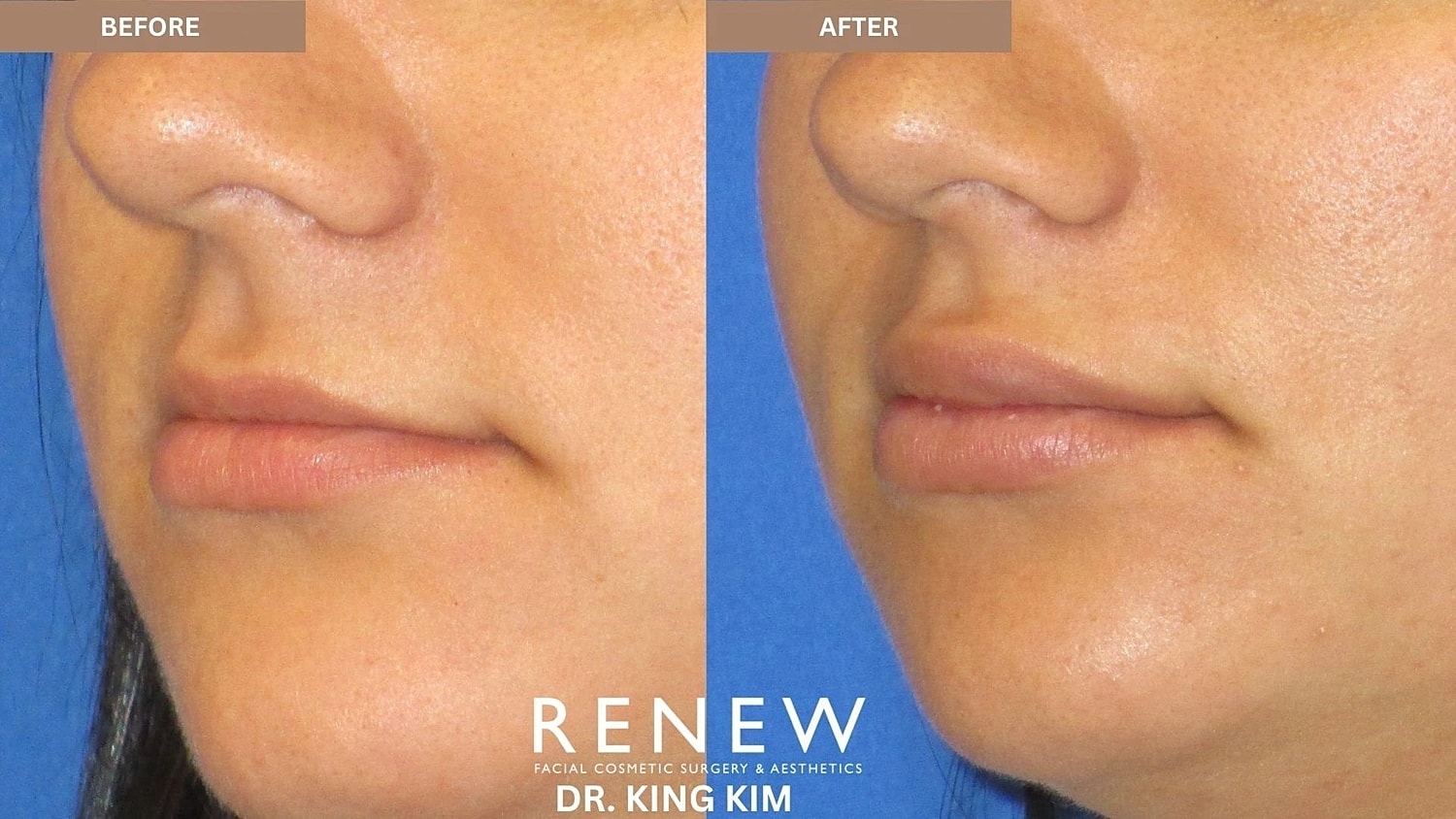Lips Before & After