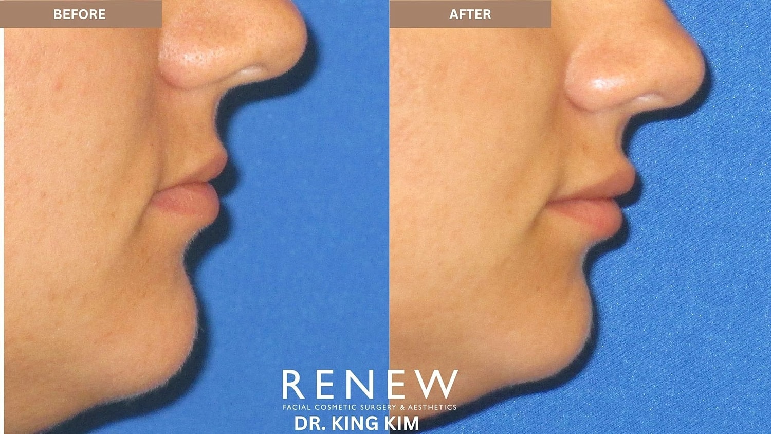 Lips Before & After