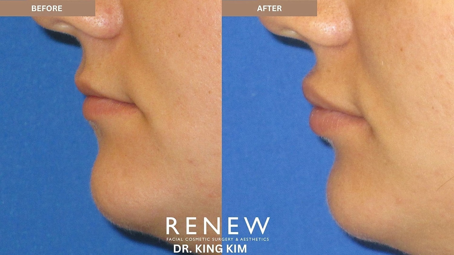 Lips Before & After