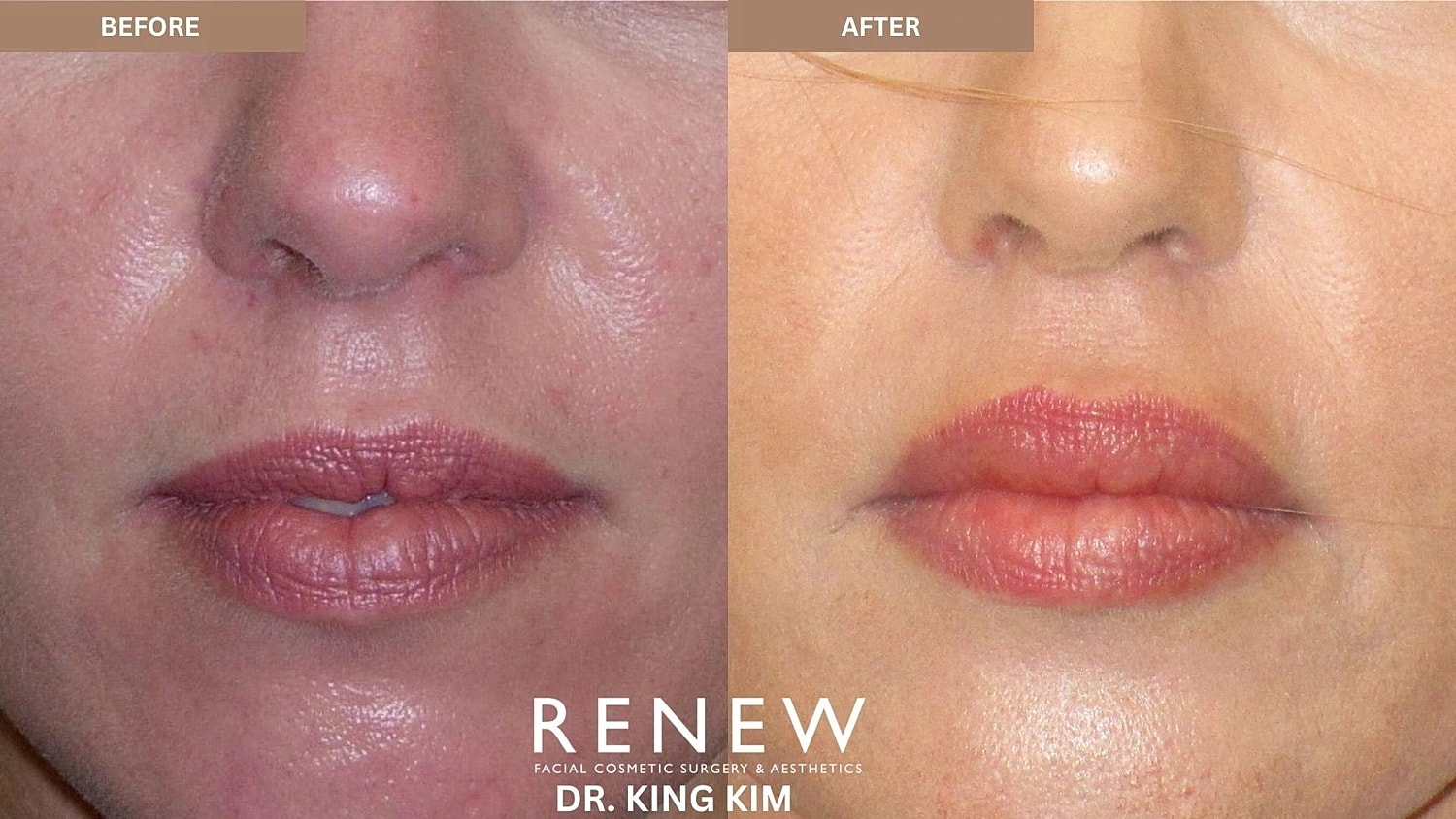 Lips Before & After