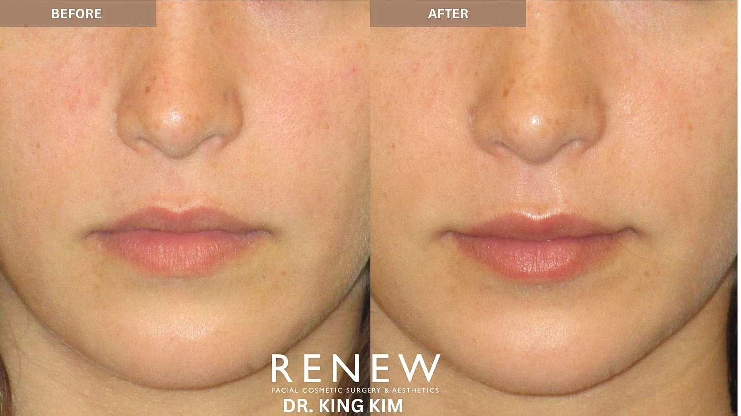 Lips Before & After