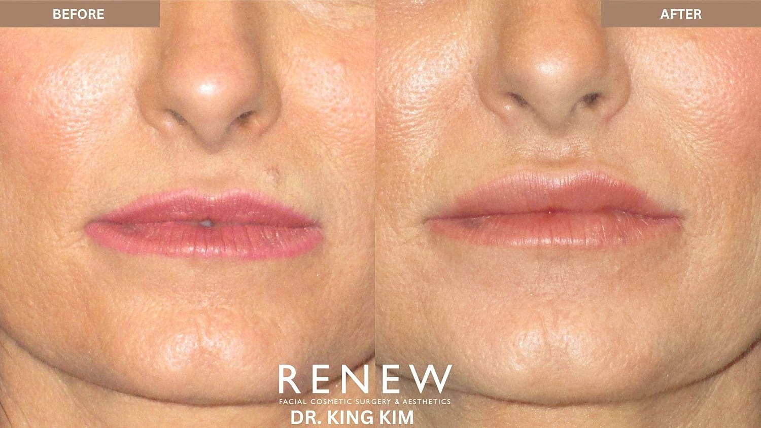 Lips Before & After