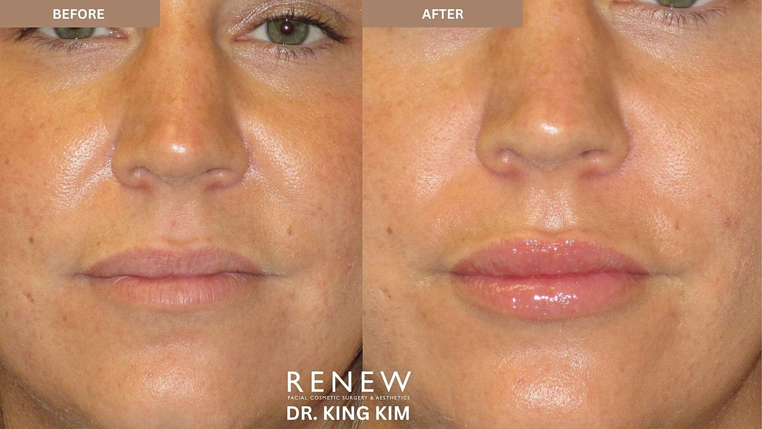 Lips Before & After