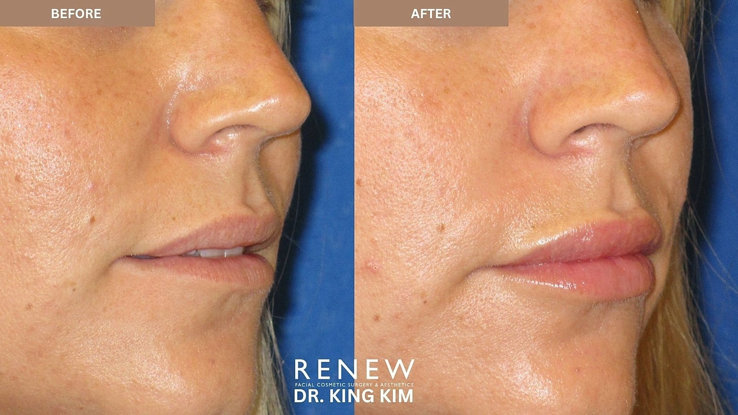 Lips Before & After