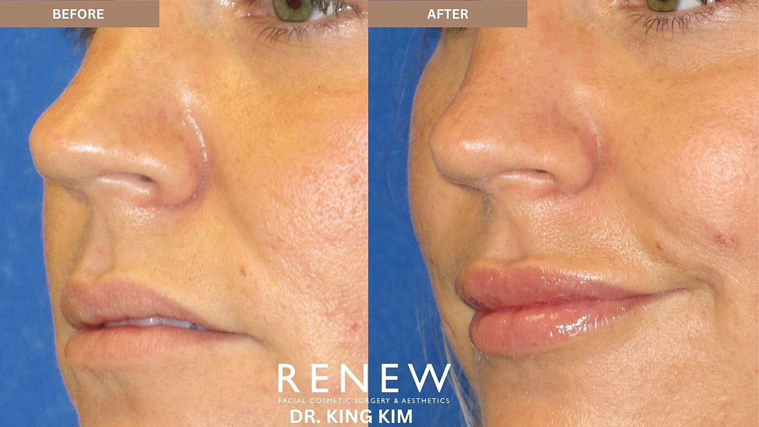 Lips Before & After