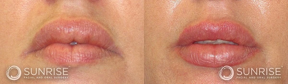 Lips Before & After