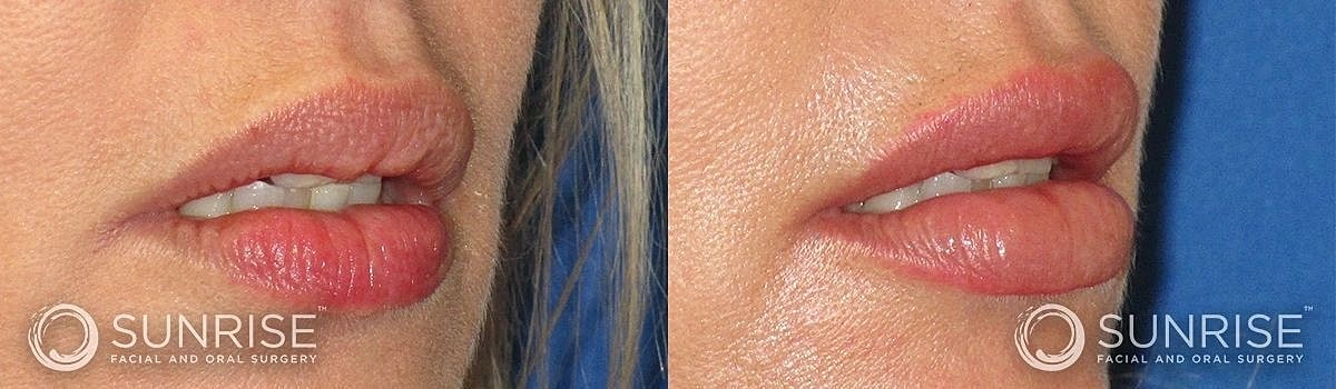 Lips Before & After