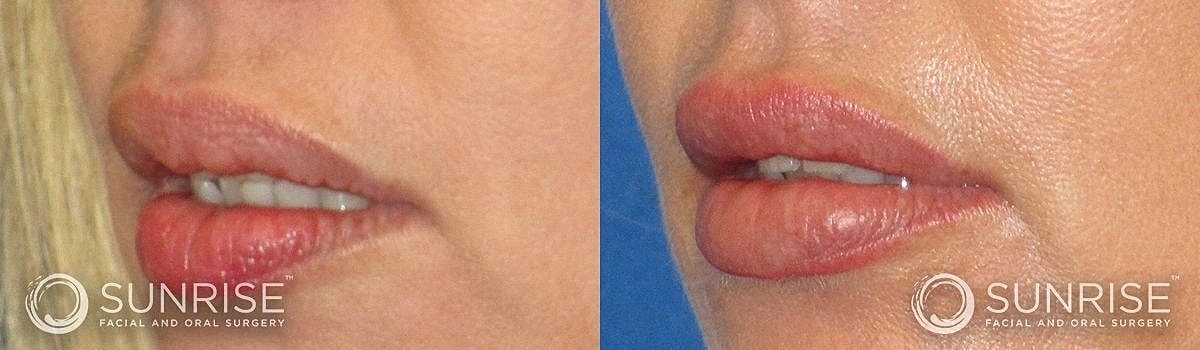 Lips Before & After
