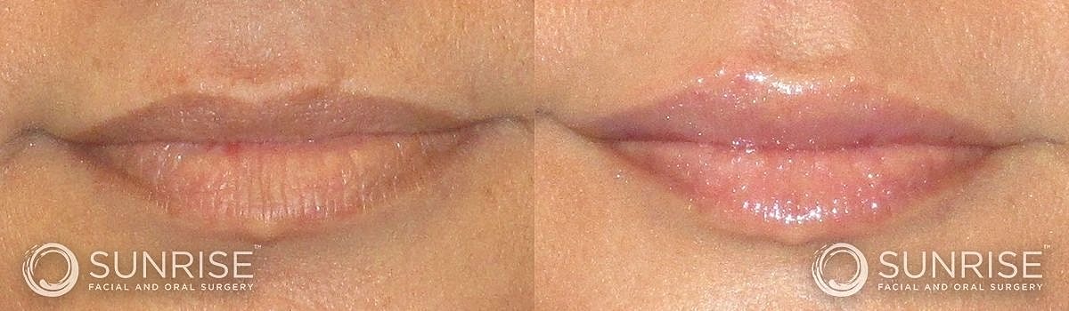 Lips Before & After
