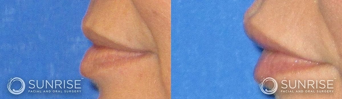 Lips Before & After