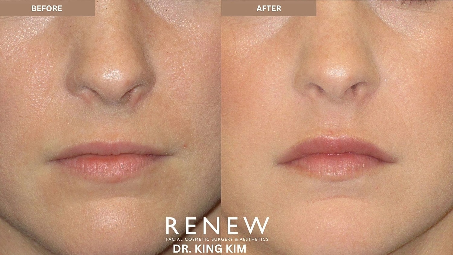 Lips Before & After
