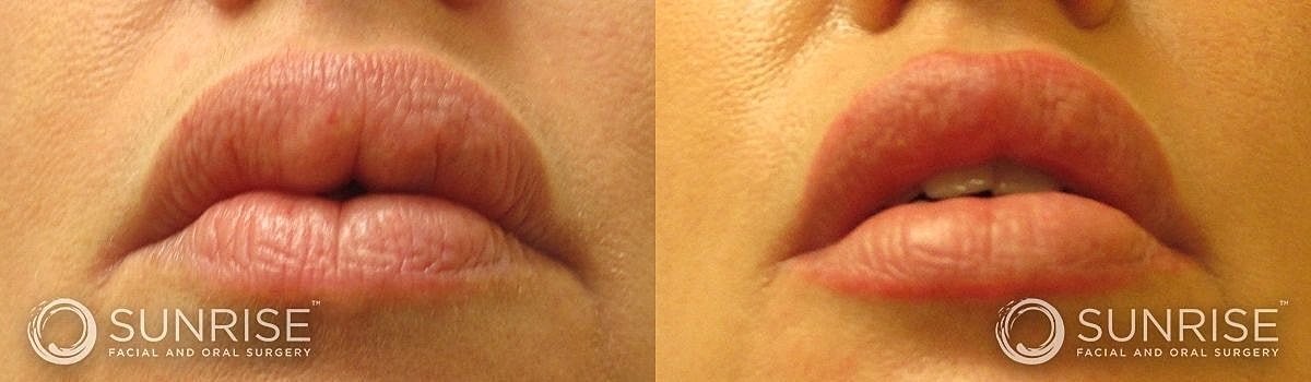 Lips Before & After
