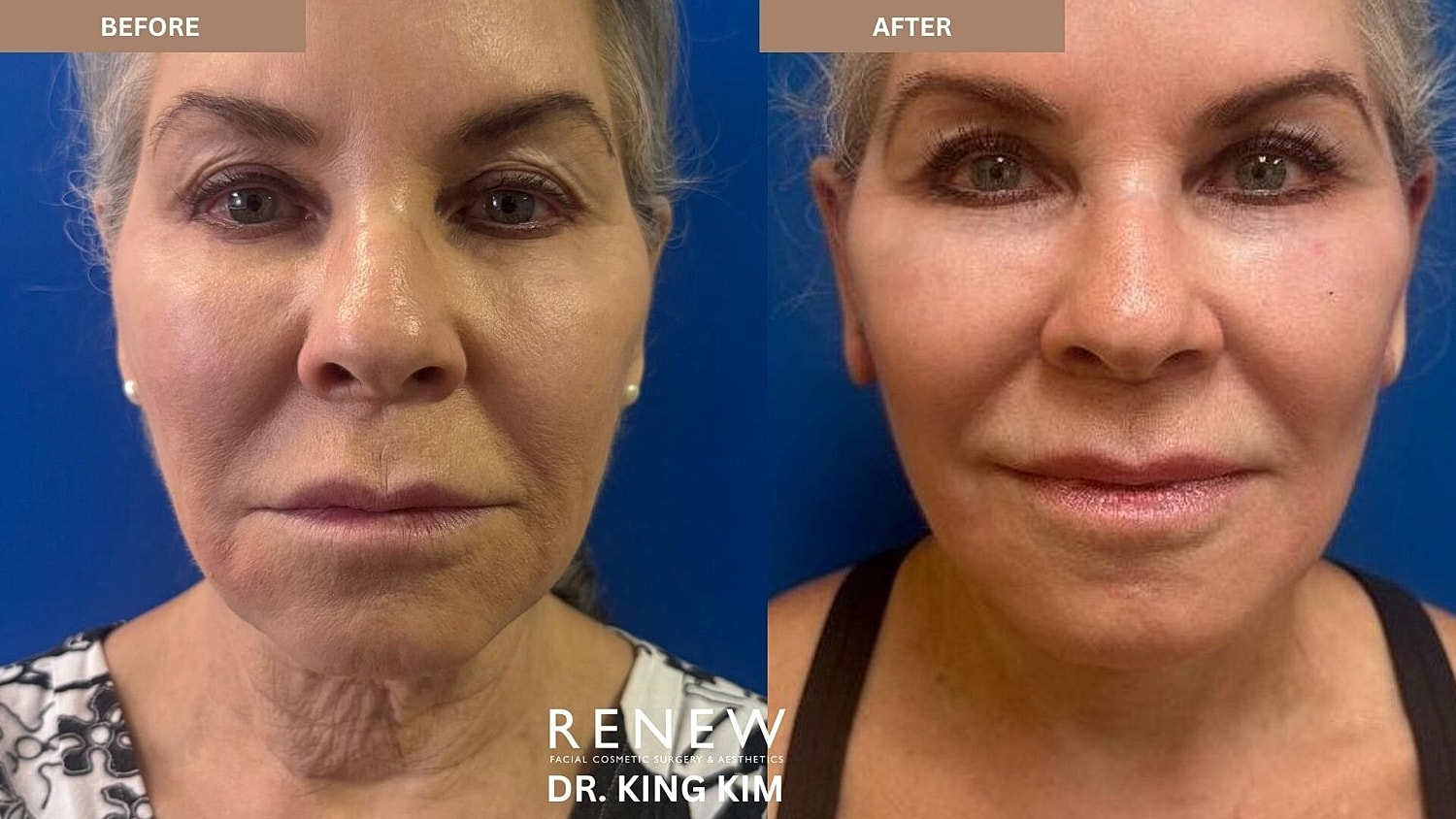 Mini Deep Plane Facelift Before & After