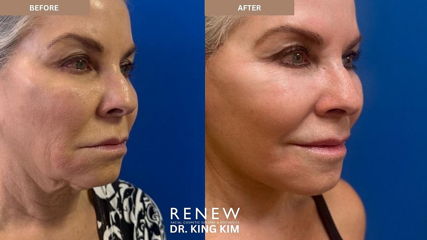Mini Deep Plane Facelift Before & After