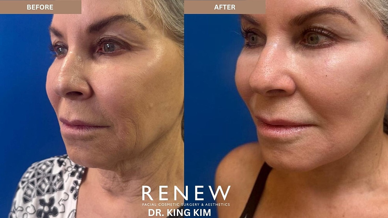 Mini Deep Plane Facelift Before & After