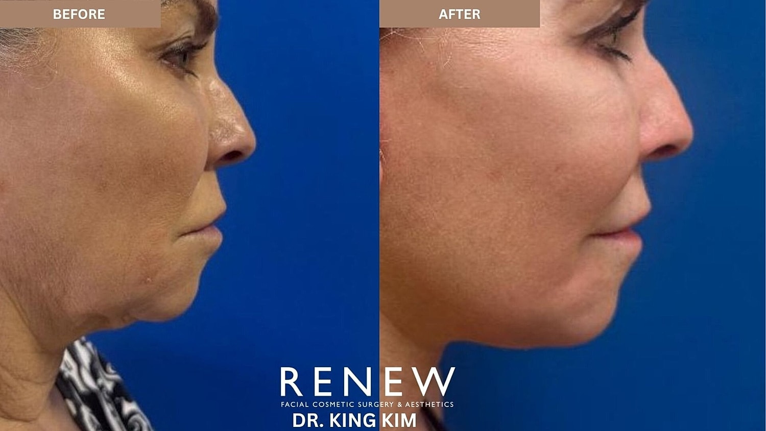 Mini Deep Plane Facelift Before & After