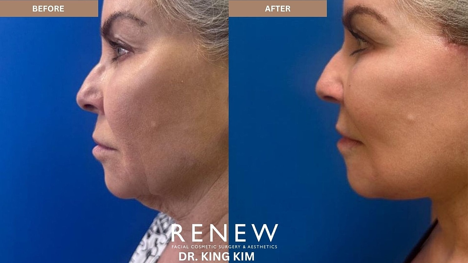 Mini Deep Plane Facelift Before & After