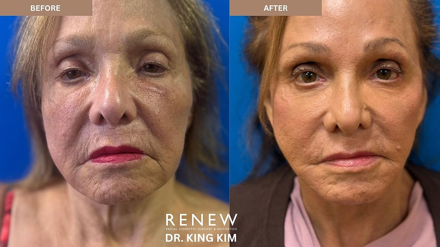 Mini Deep Plane Facelift Before & After