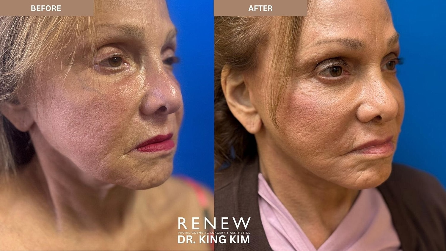 Mini Deep Plane Facelift Before & After