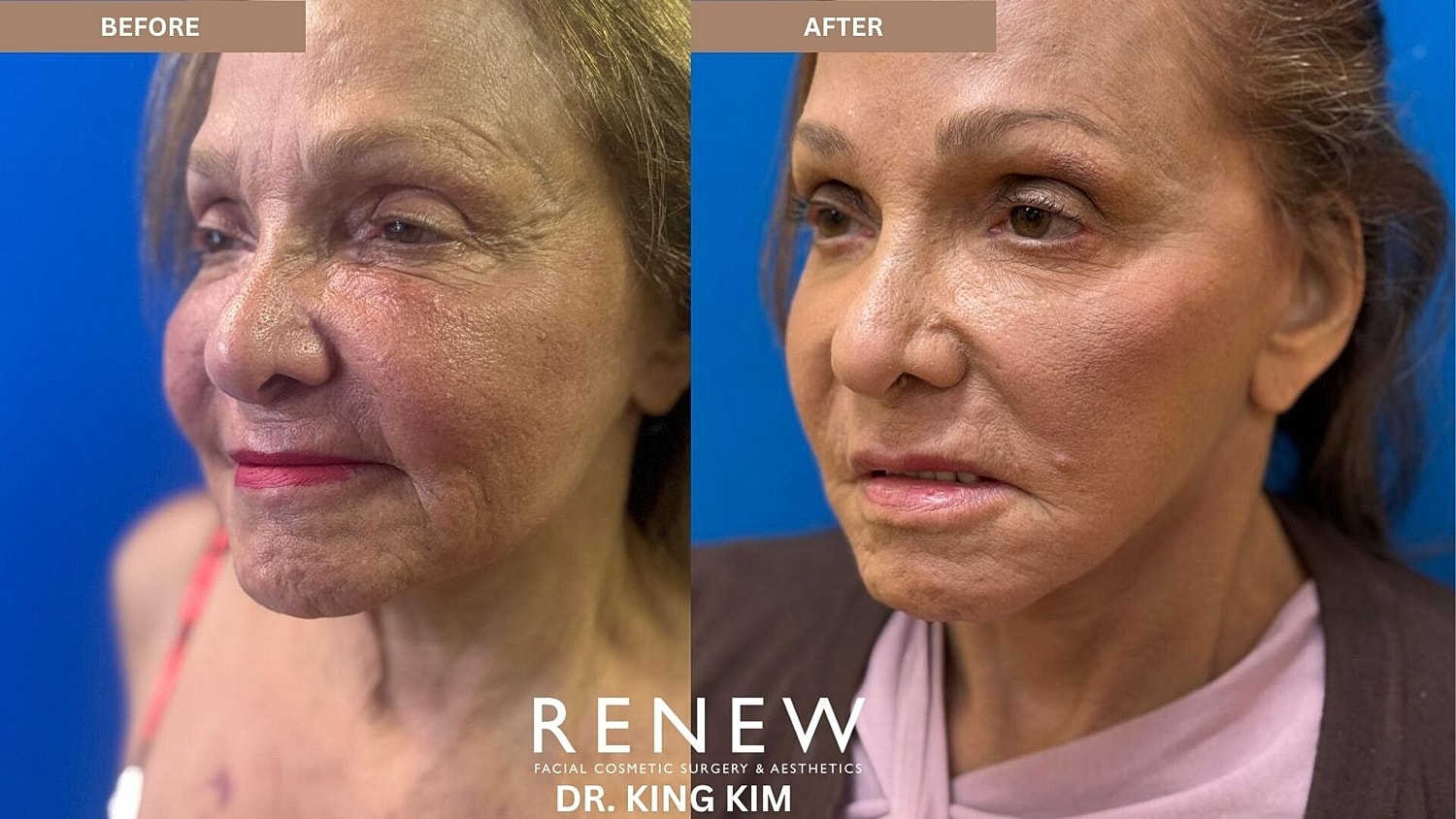 Mini Deep Plane Facelift Before & After