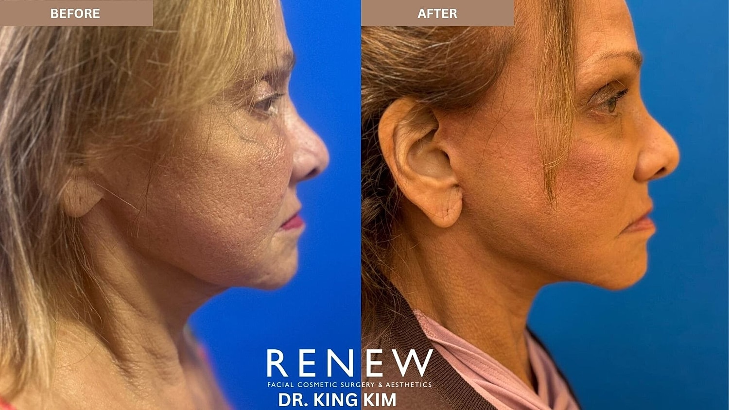 Mini Deep Plane Facelift Before & After