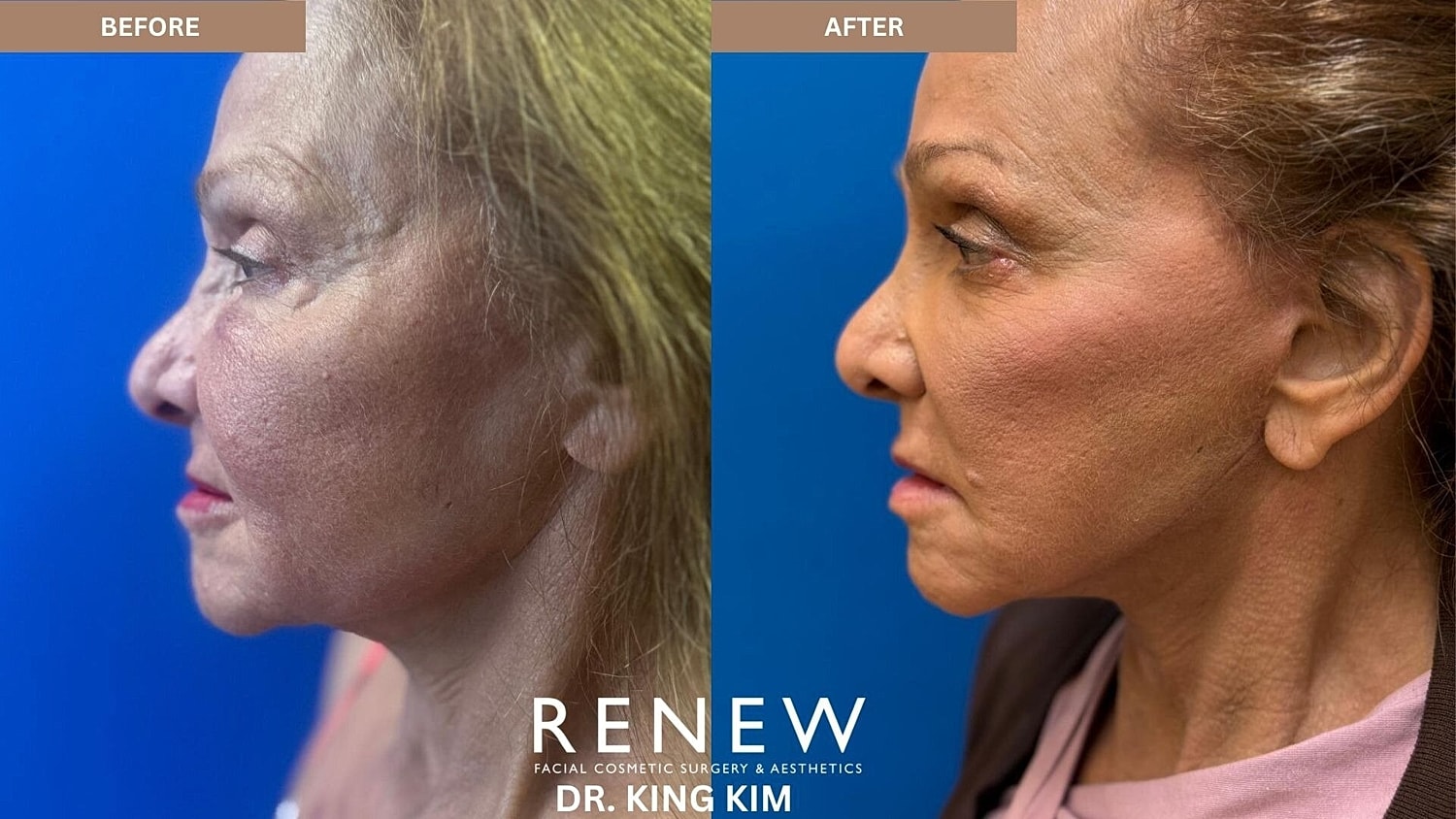 Mini Deep Plane Facelift Before & After