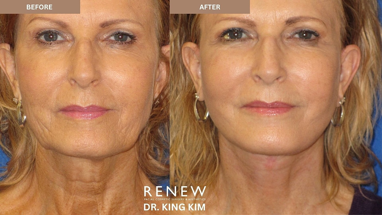Mini Deep Plane Facelift Before & After