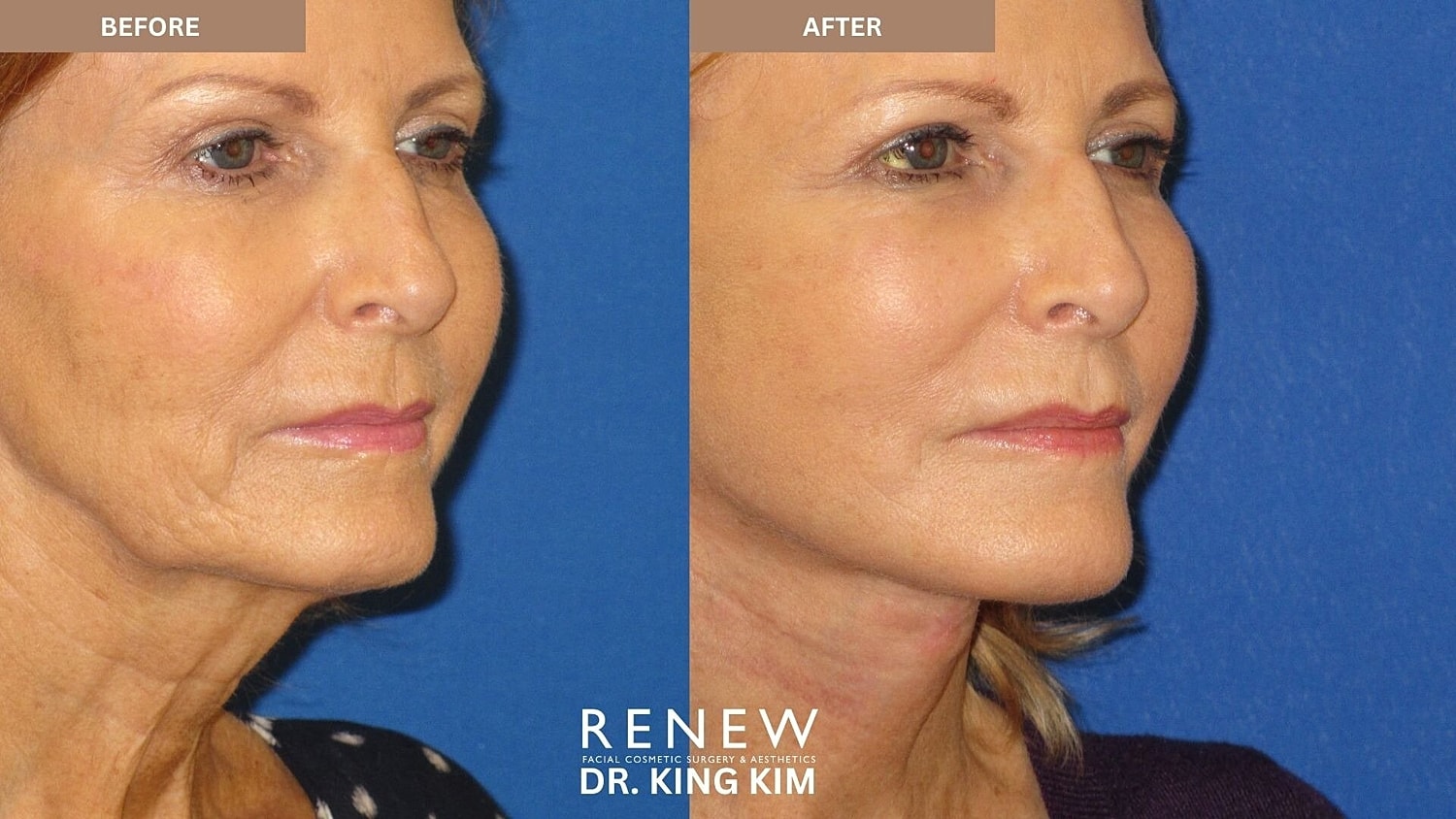 Mini Deep Plane Facelift Before & After