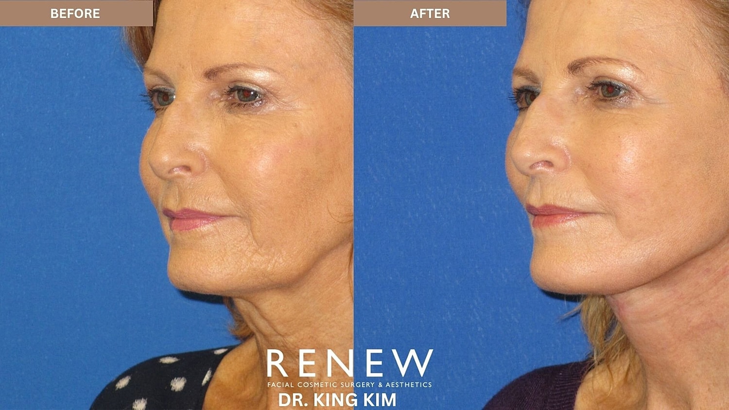 Mini Deep Plane Facelift Before & After