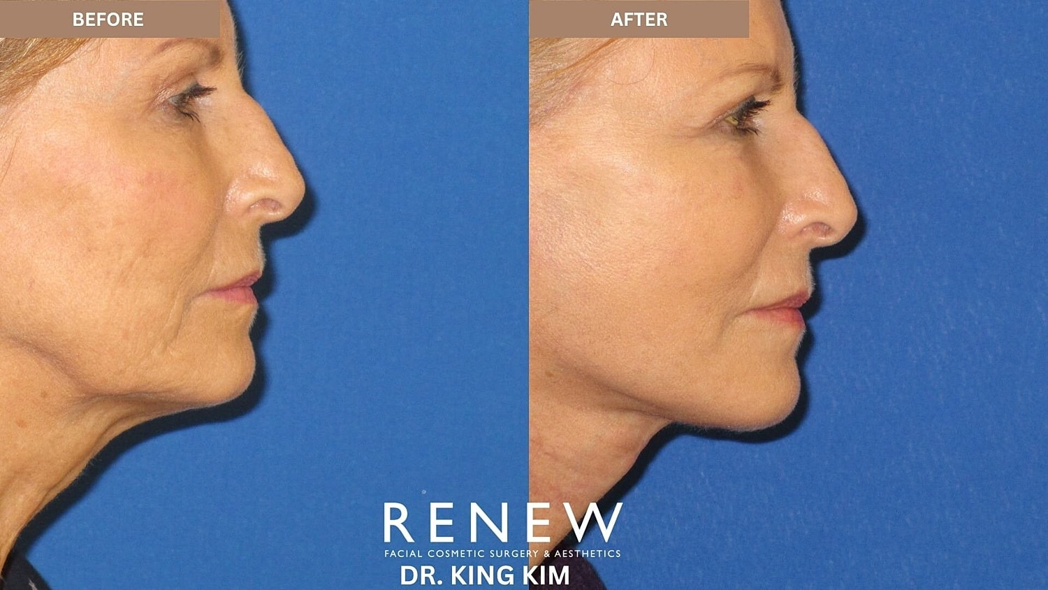 Mini Deep Plane Facelift Before & After