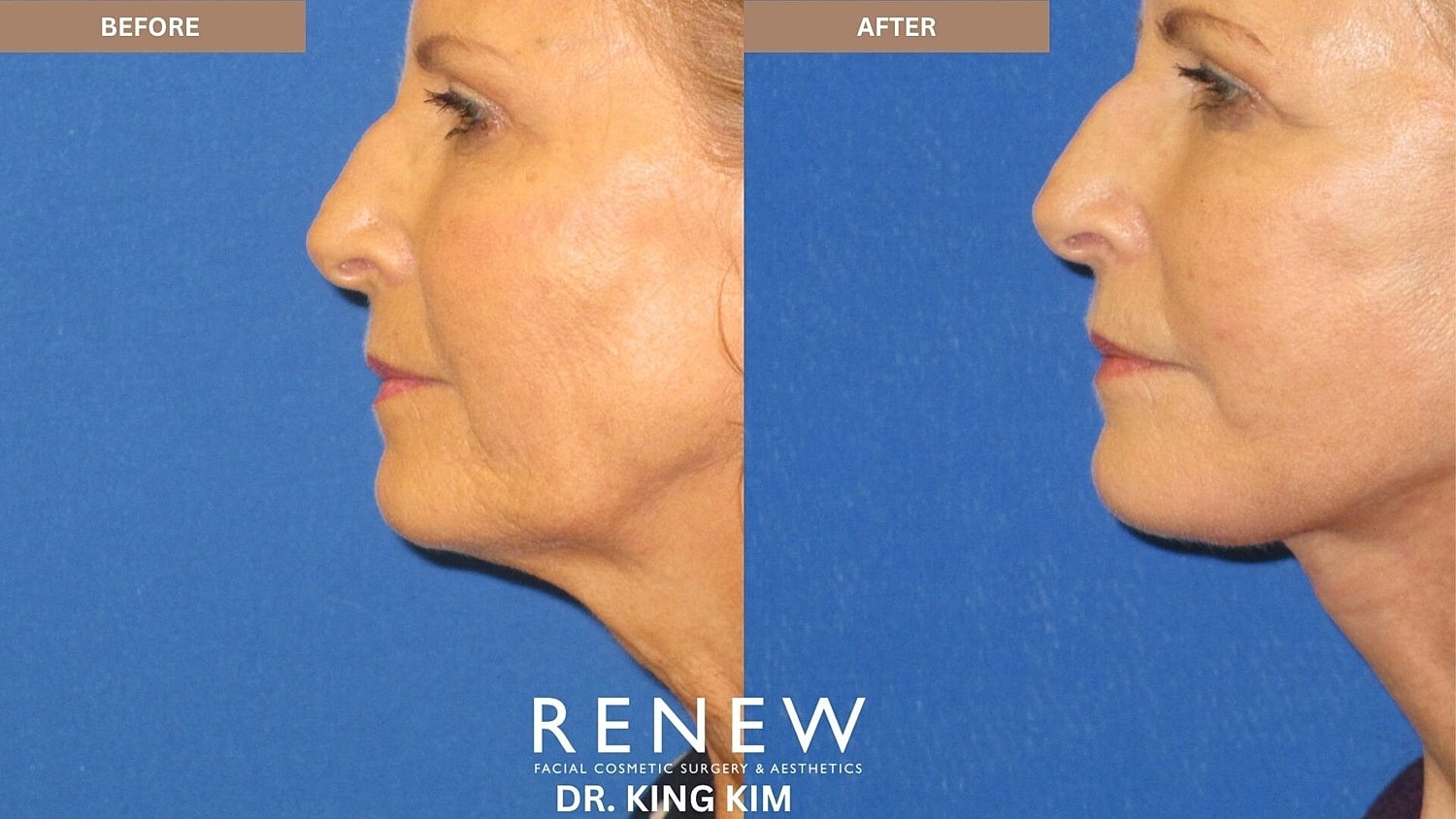 Mini Deep Plane Facelift Before & After