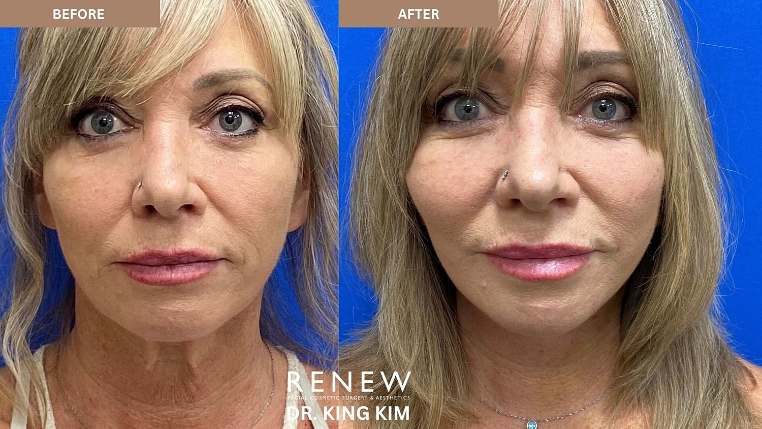 Mini Deep Plane Facelift Before & After