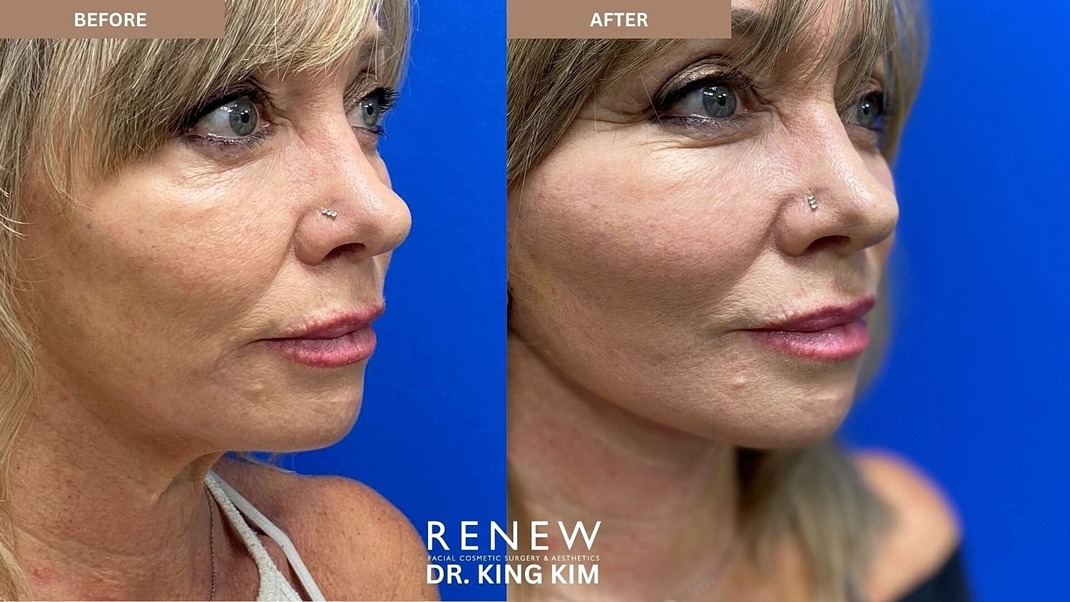 Mini Deep Plane Facelift Before & After