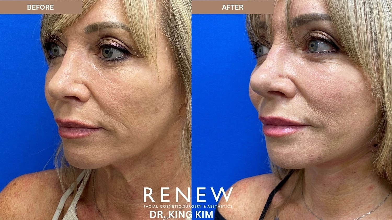 Mini Deep Plane Facelift Before & After