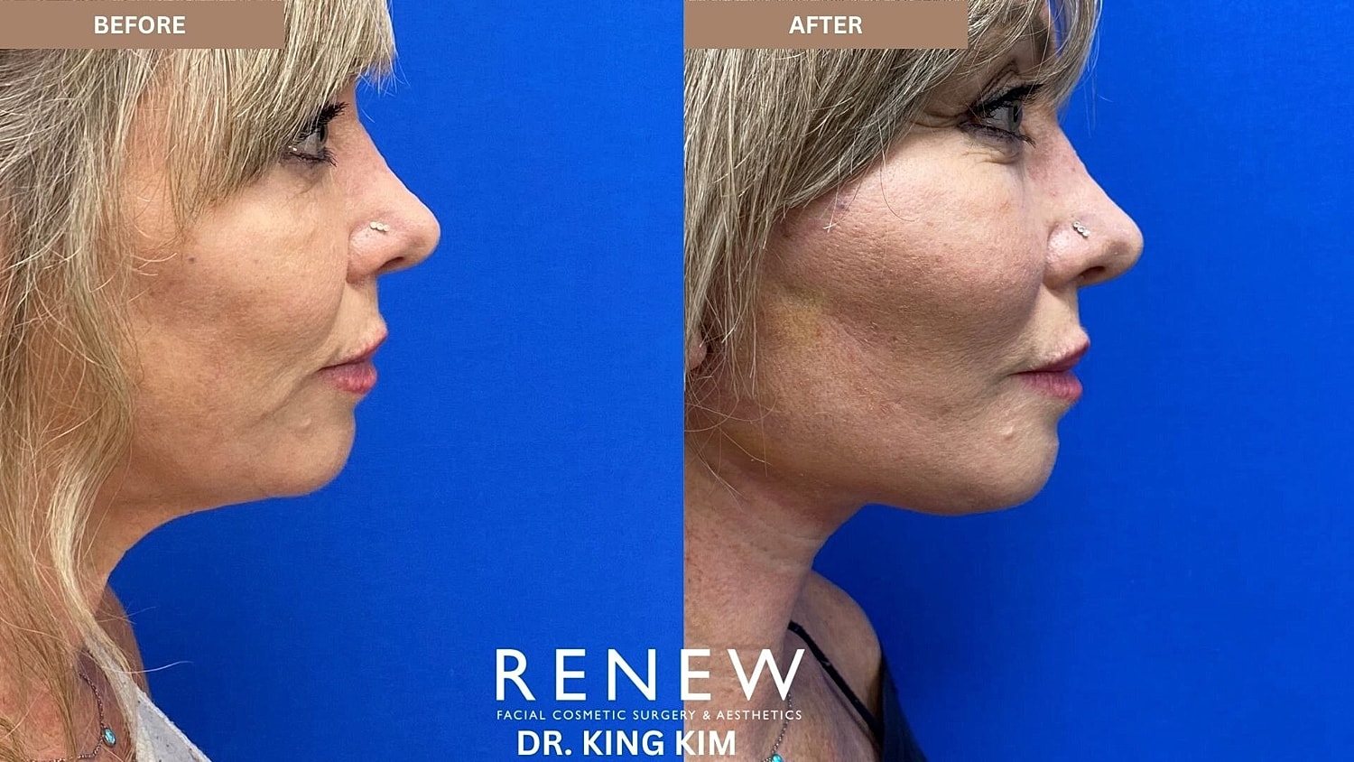 Mini Deep Plane Facelift Before & After