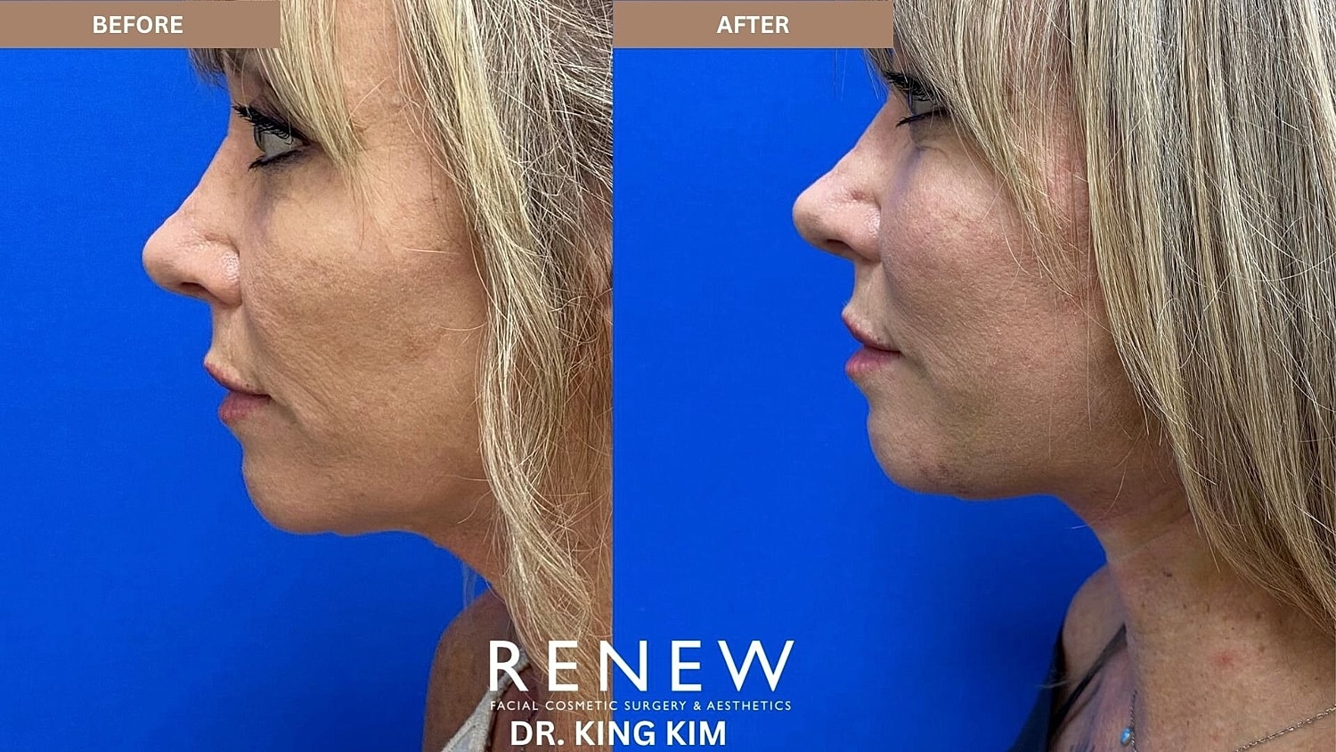 Mini Deep Plane Facelift Before & After