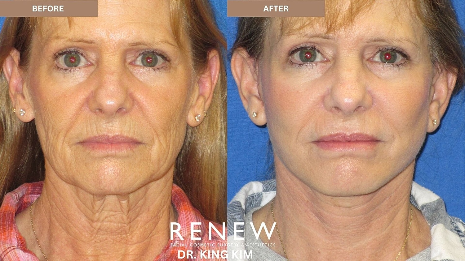 Mini Deep Plane Facelift Before & After