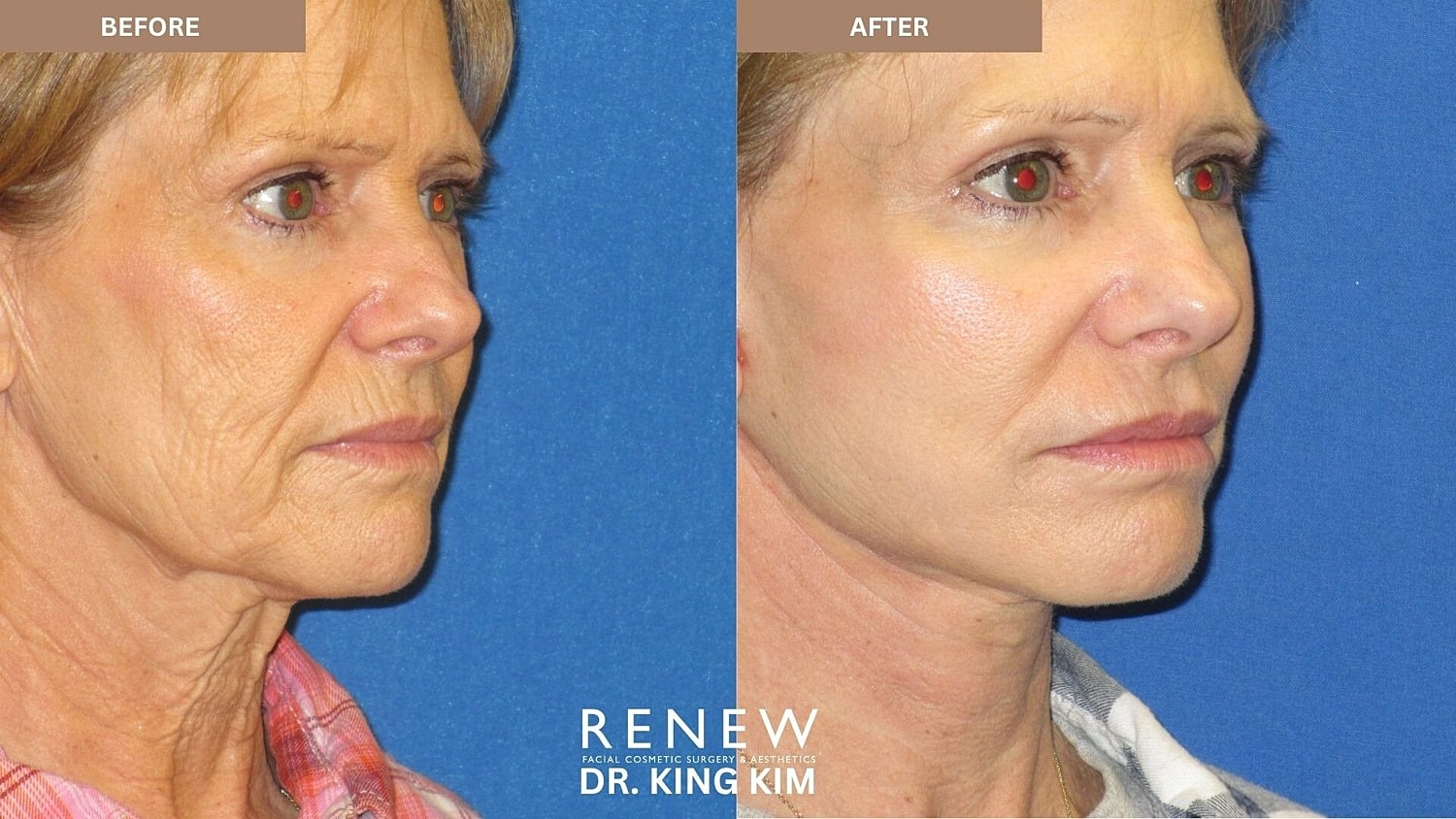Mini Deep Plane Facelift Before & After