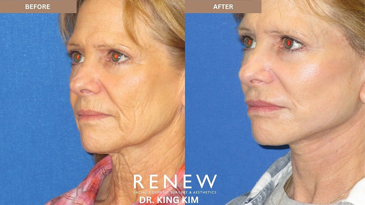 Mini Deep Plane Facelift Before & After