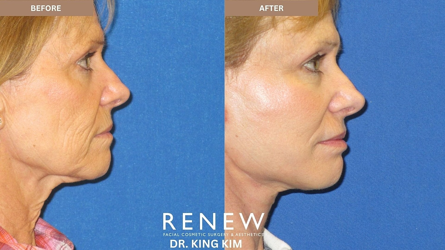 Mini Deep Plane Facelift Before & After