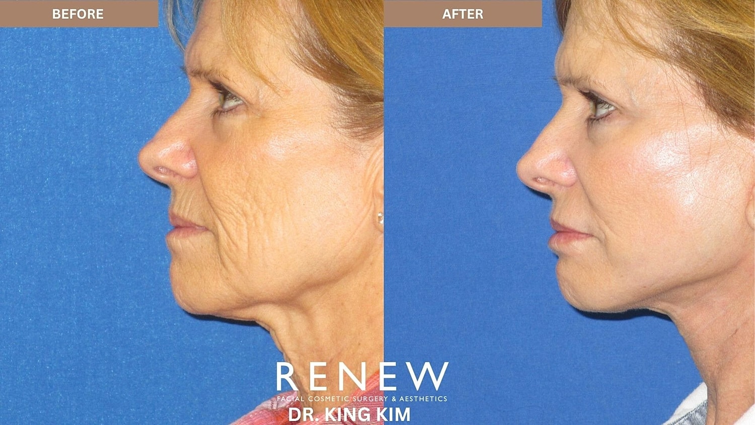 Mini Deep Plane Facelift Before & After