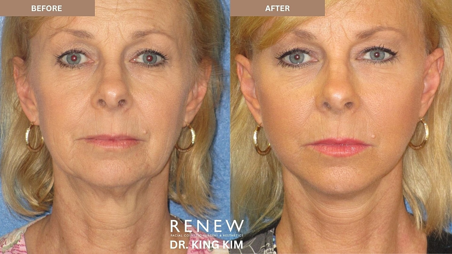 Mini Deep Plane Facelift Before & After