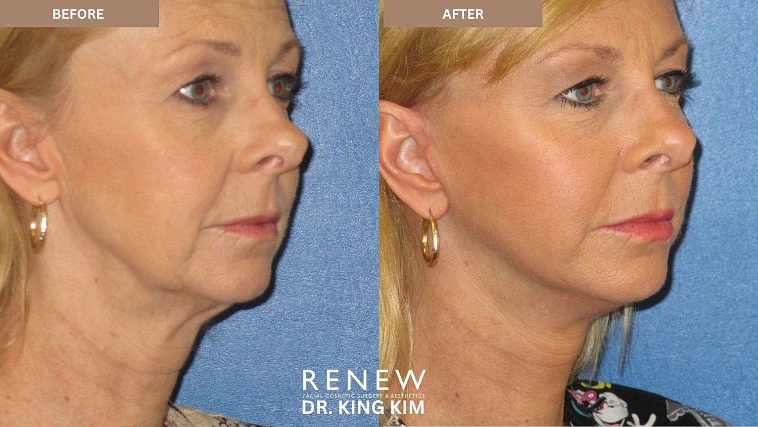 Mini Deep Plane Facelift Before & After